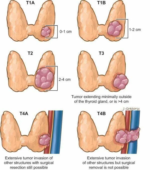 Рак щитовидной железы симптомы у женщин фото Pin on thyroid awareness