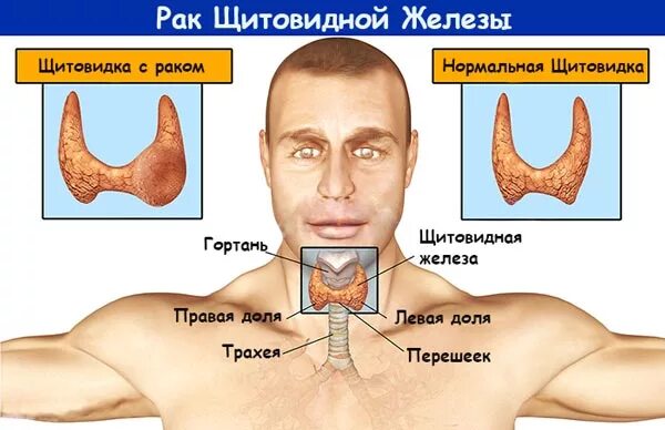 Рак щитовидной железы симптомы у женщин фото Щитовидная железа