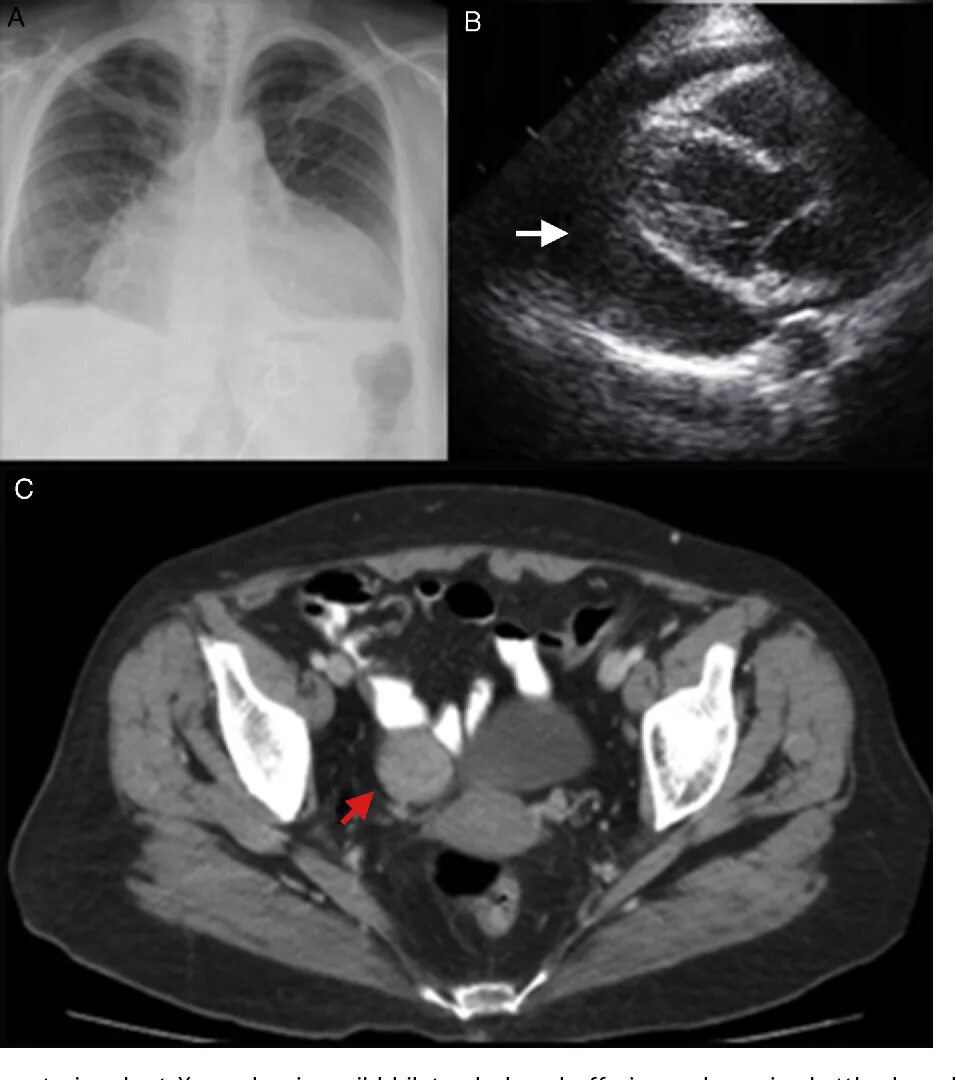 Рак сердца фото Meigs-like syndrome presenting as cardiac tamponade. Semantic Scholar