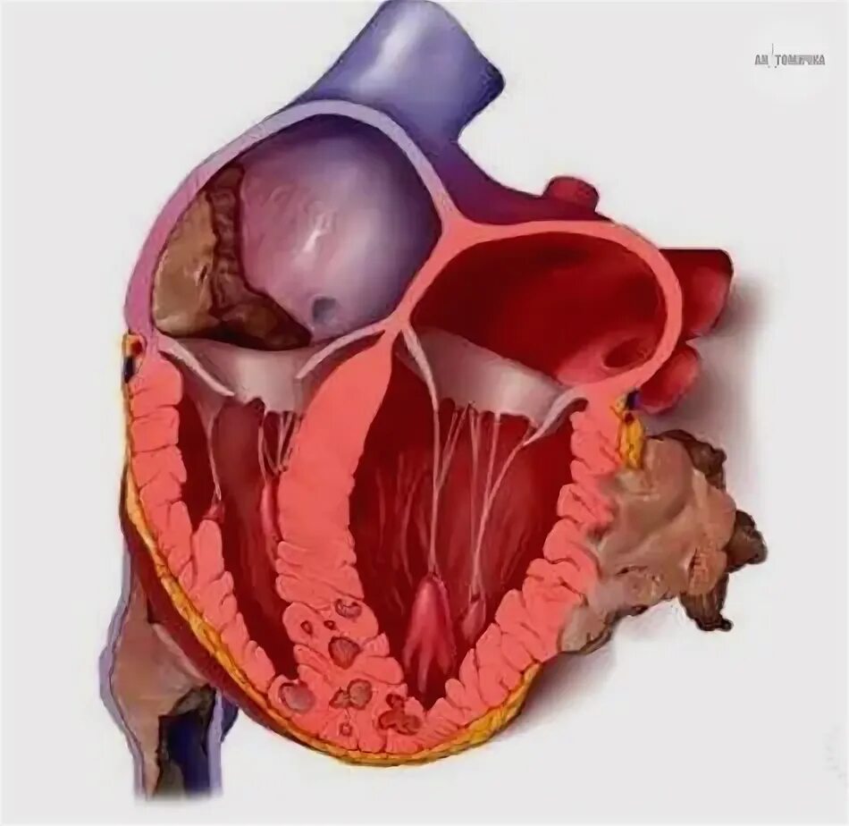 Рак сердца фото Миксома - это опухоль, которая развивается в левом предсердии сердца. Она обычно