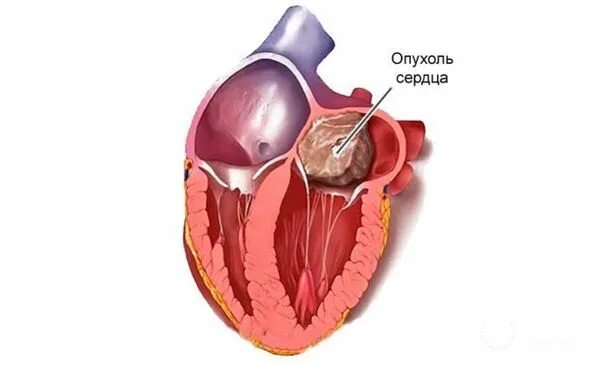 Рак сердца фото Опухоли сердца: причины, симптомы и лечение в статье кардиолога Маслова Ю. А.