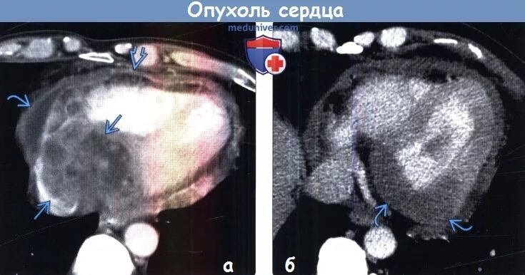 Рак сердца фото Примеры диагностики опухоли сердца по рентгену, КТ, МРТ