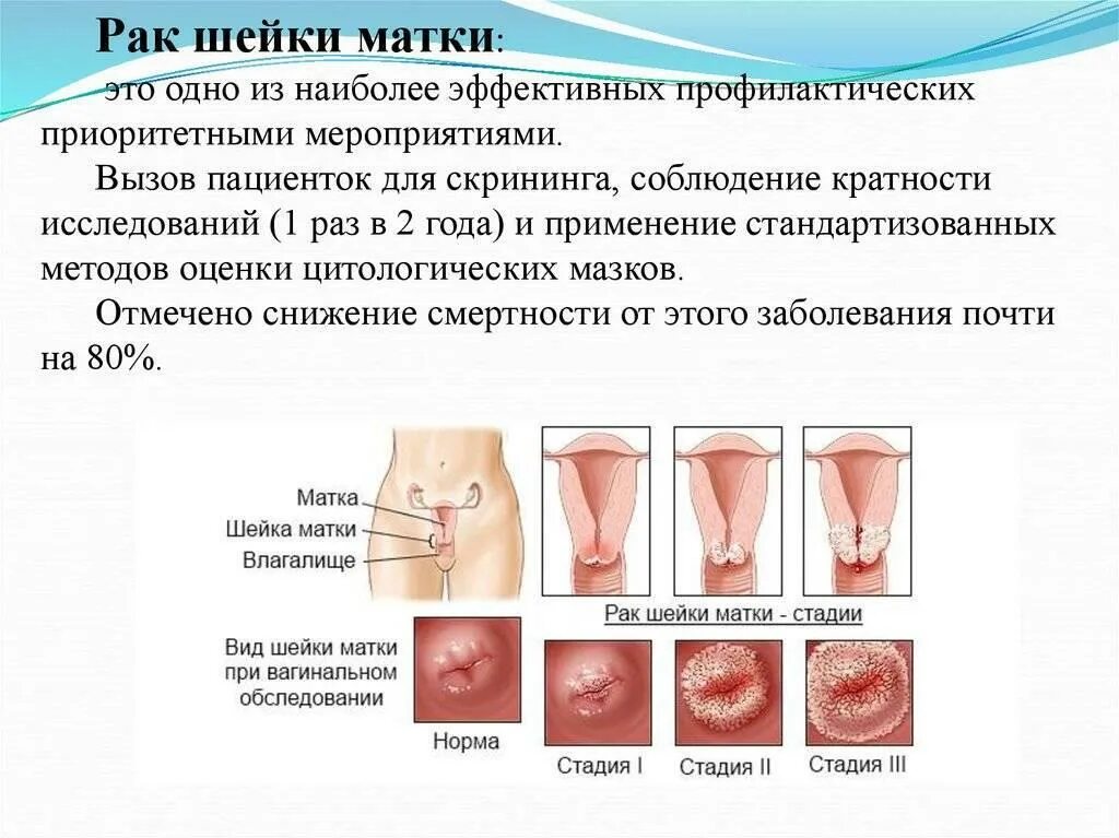 Рак шейки матки 1 стадия фото Профилактика рака шейки матки.