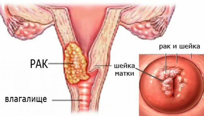 Рак шейки матки симптомы и признаки фото Рак шейки матки: симптомы, диагностика и лечение "Санталь Новосибирск" (на Левом