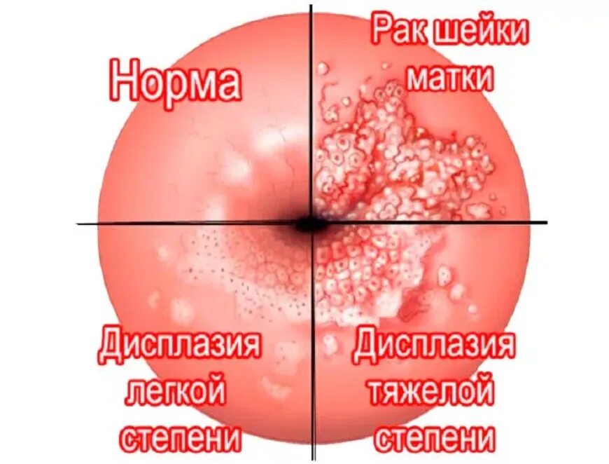 Рак шейки матки симптомы и признаки фото Легкая дисплазия шейки матки - что это и как лечить? - Хирург К. В. Пучков