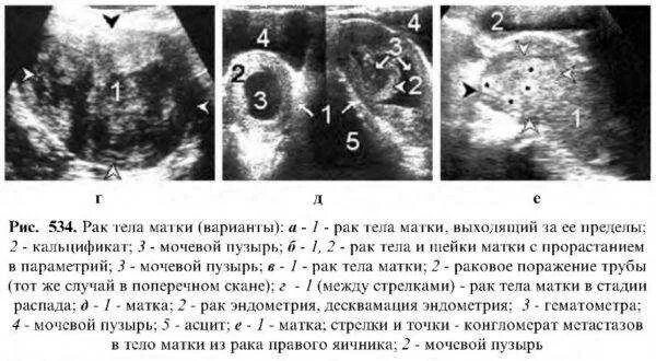 Рак шейки матки симптомы у женщин фото Лейкоплакия шейки матки: начнется ли рак