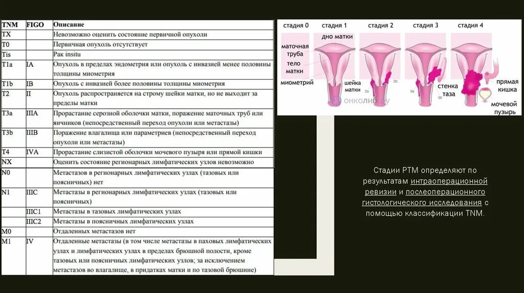 Рак шейки матки стадии фото Рак матки клинические