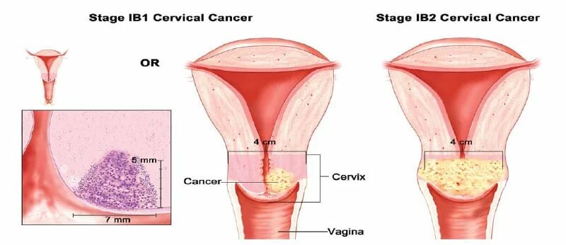 Рак шейки матки стадии фото January is carnival cancer awareness month - Hua Hin Today - Your Premier Source