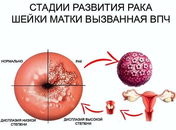 Рак шейки матки стадии фото Рак шейки матки - симптомы и признаки, диагностика, лечение