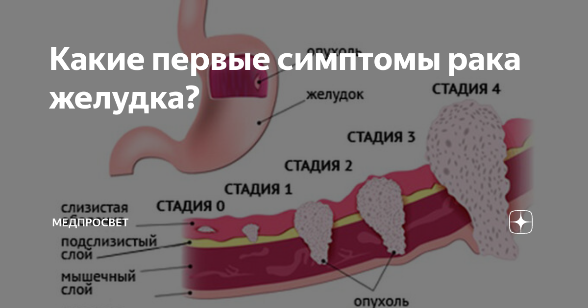 Рак симптомы фото первые признаки рака Что делать при онкологии 4 стадии