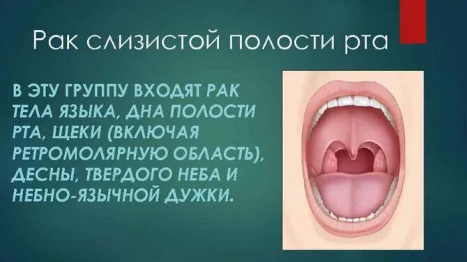 Рак слизистой рта фото начальная стадия Грибок в горле - симптомы и лечение грибковых заболеваний горла