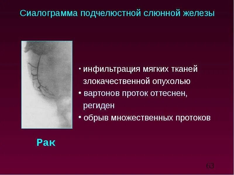 Рак слюнной железы симптомы и фото Лучевая диагностика Слюнных Желез - презентация, доклад, проект скачать