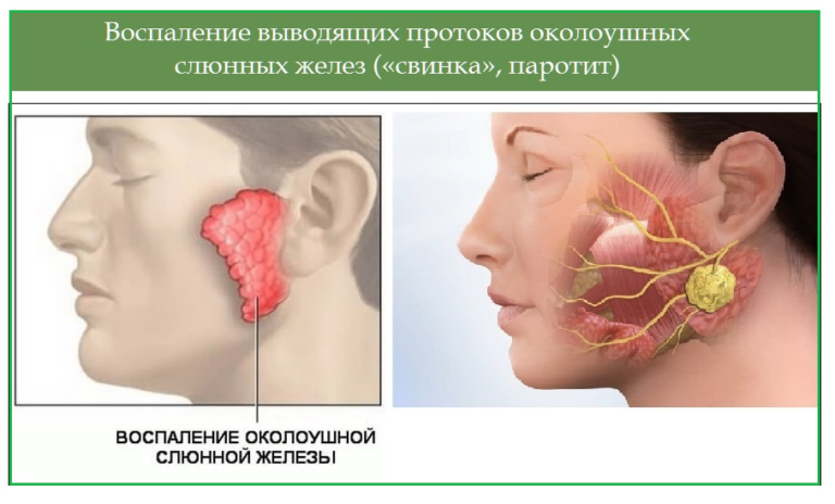 Рак слюнной железы симптомы и фото Психосоматика свинка паротит, причины, примеры