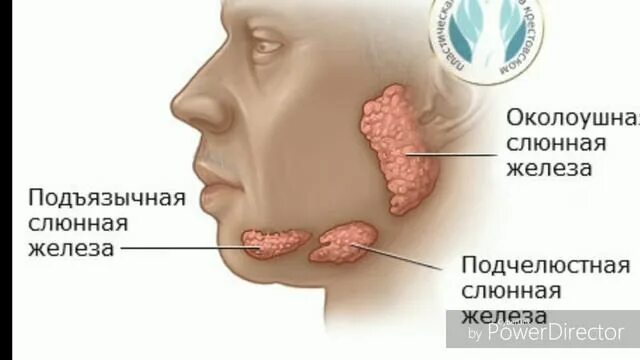 Рак слюнных желез симптомы фото Подчелюстная слюнная железа. Терапевтическая стоматология. Вопросы на экзаменах.