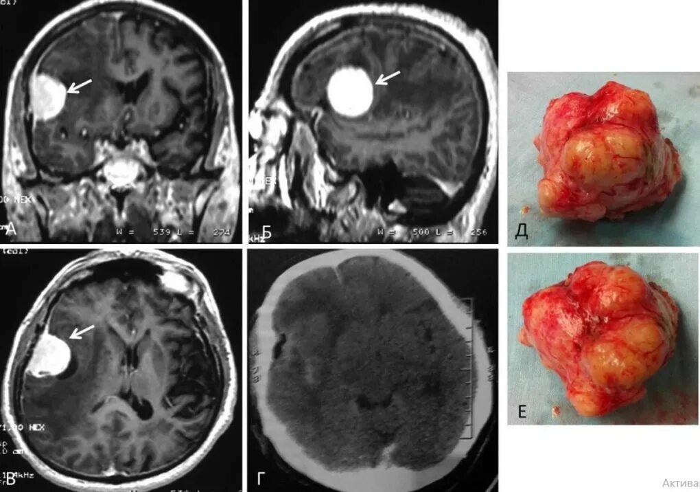 Рак снаружи фото Терапия менингиомы