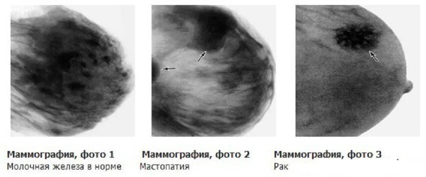 Рак соска молочной железы симптомы фото Рак груди 4 стадии: симптомы, лечение, прогноз патологии