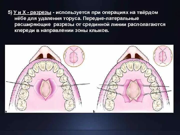 Рак твердого неба фото Воспаление твердого неба - Арт Минск.ру