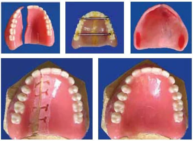 Рак твердого неба фото Починка, коррекция, перебазировка съемного протеза полного зубного ряда (1077) -