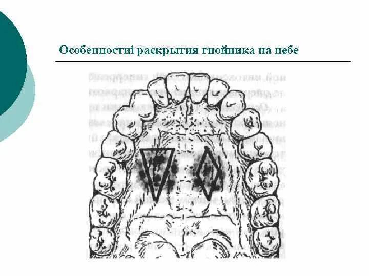 Рак твердого неба фото как выглядит Рак Твердого Неба Фото - Karevaphoto.ru