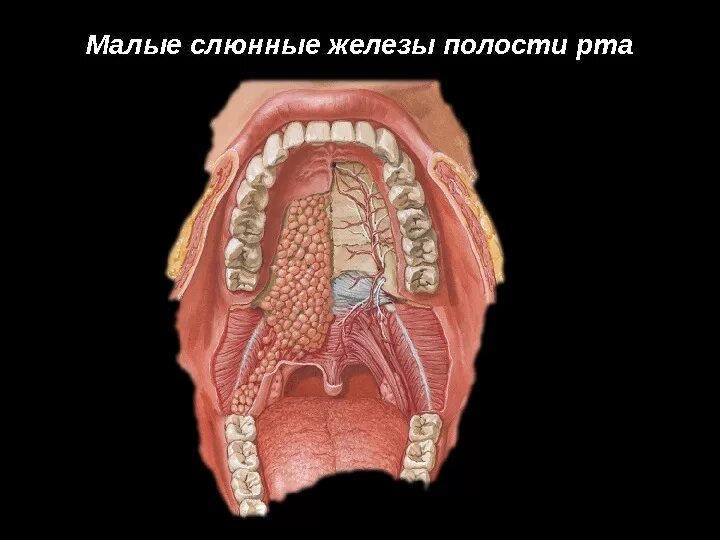 Рак твердого неба симптомы фото Анатомия слюнных желез Воспалительные заболевания слюнных желез