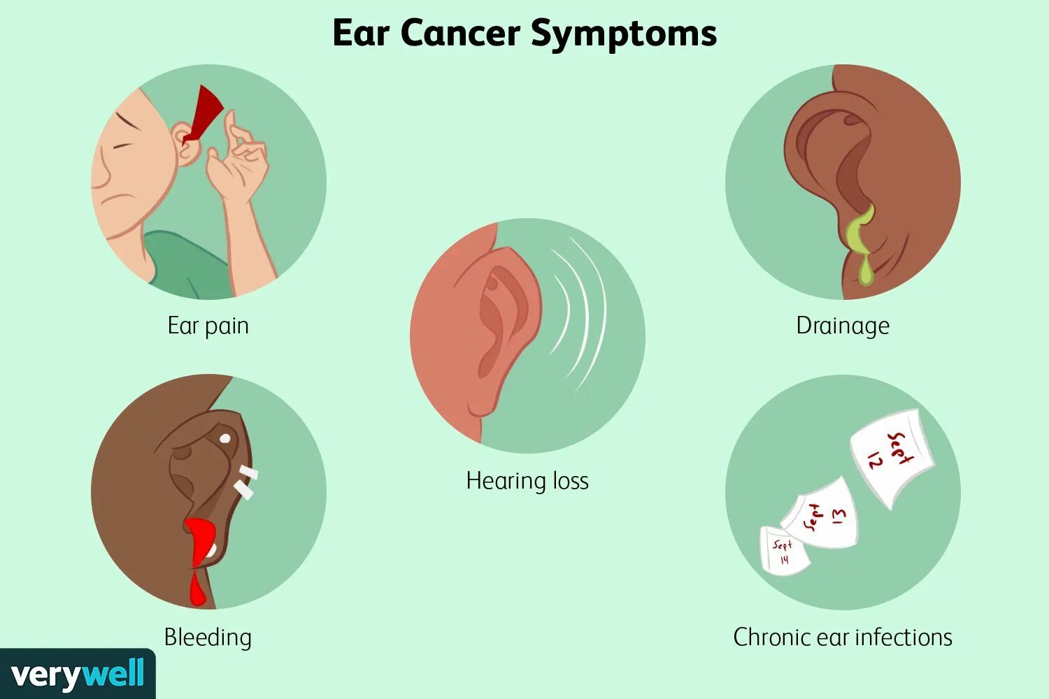 Рак уха фото Ear Cancer: Types, Causes, and Treatments