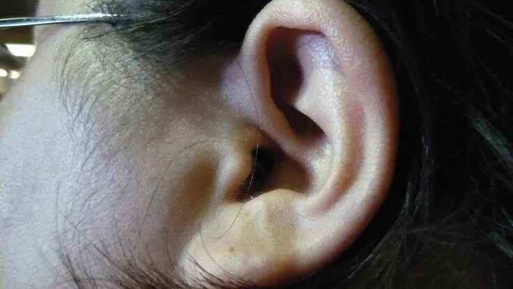 Рак уха фото наружного симптомы Tuning Out Tinnitus: New Study Indicates Possible New Therapy for This Condition