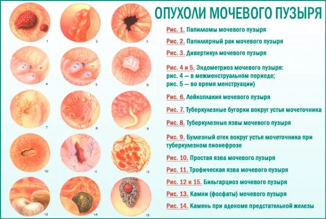 Рак уретры у женщин симптомы фото Симптоми раку сечового міхура у жінок на ранній стадії. Причини, діагностика та 