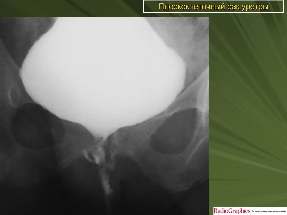 Рак уретры у женщин симптомы фото МПС. Мочевая система. Заболевания уретры. + Портал радиологов