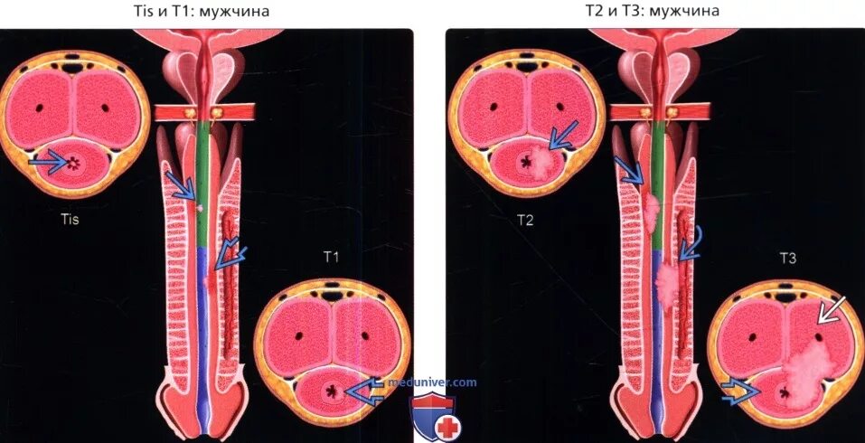 Рак уретры у женщин симптомы фото Рак уретры у мужчин: причины, симптомы, лечение