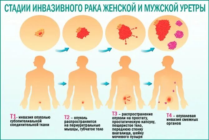 Рак уретры у женщин симптомы фото Рак мочеиспускательного канала у женщин: симптомы уретральной опухоли