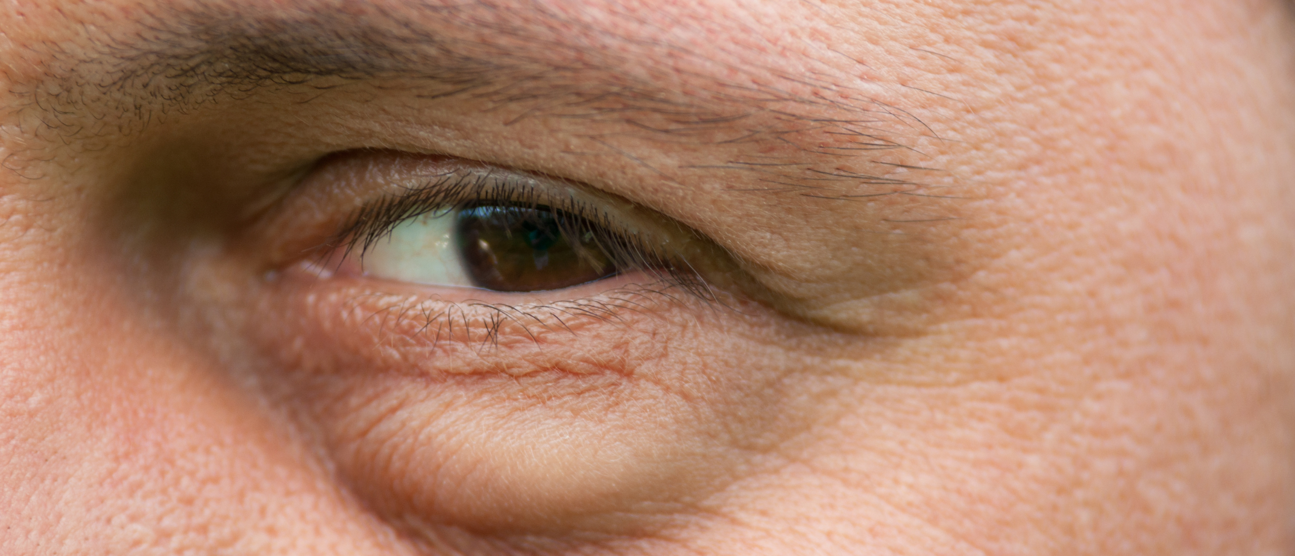 Eyelid Cancer - All About Vision