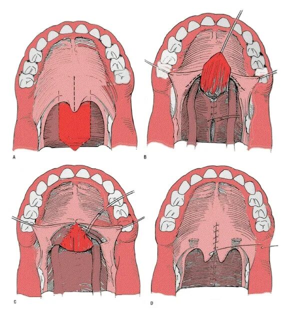 Рак верхнего неба фото Рака неба во рту - Olphoto.ru