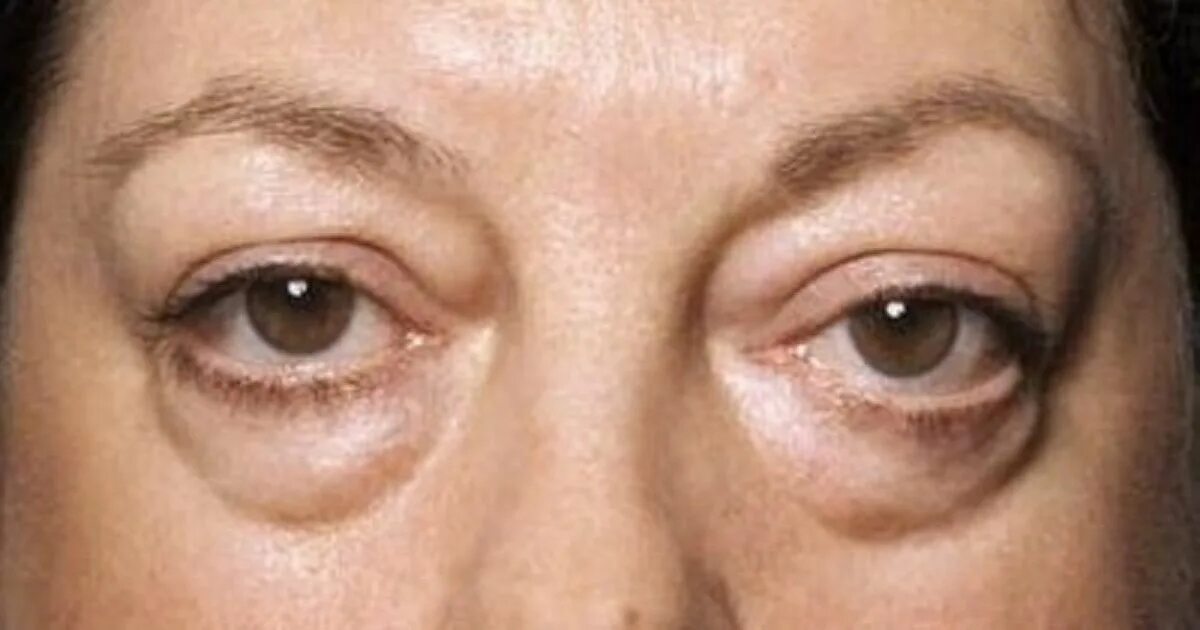 Рак верхнего века фото симптомы Get Help for Those Baggy Bags Under Your Eyes Eye bags, Under eye wrinkles, Beau