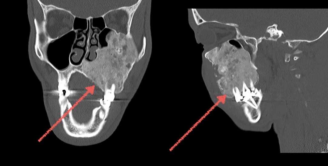 Рак верхней челюсти фото Гранулема височной кости