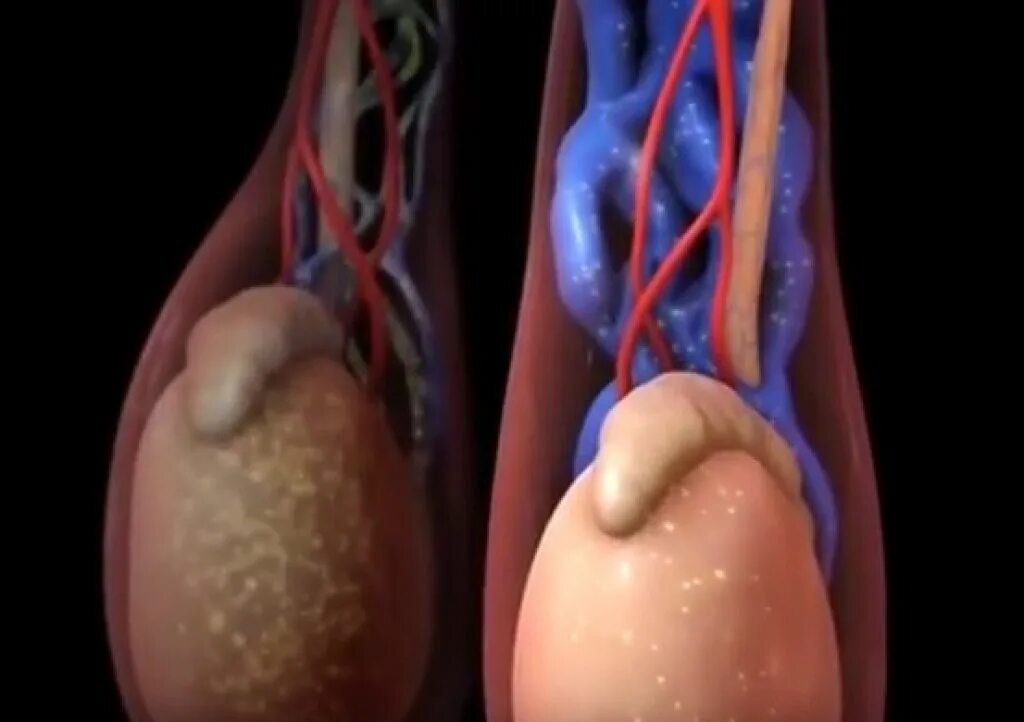 Рак яичек симптомы фото Картинки ВАРИКОЦЕЛЕ ЯИЧЕК ЛЕЧЕНИЕ