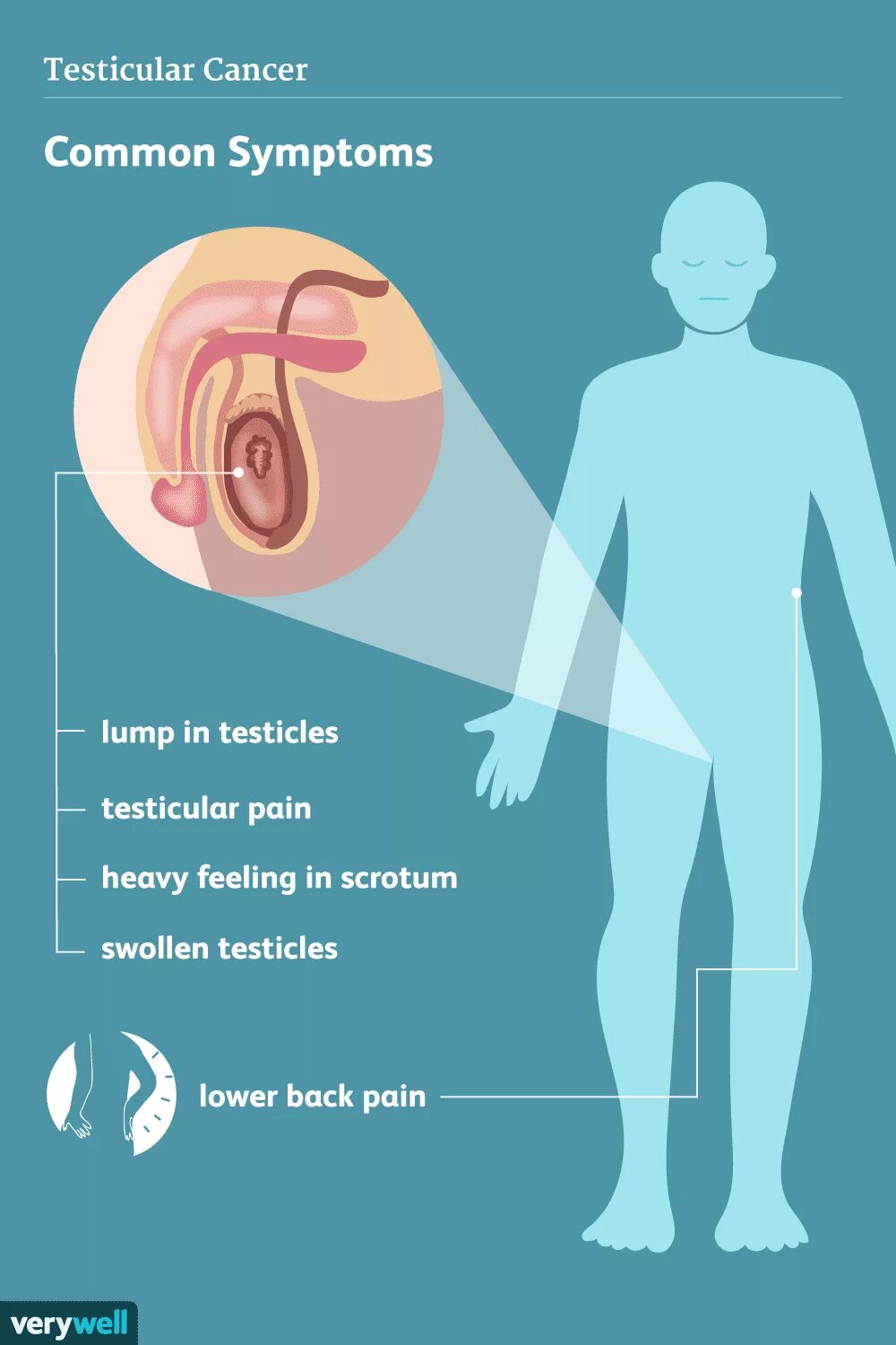 Рак яичек симптомы фото Signs, Symptoms, and Complications of Testicular Cancer