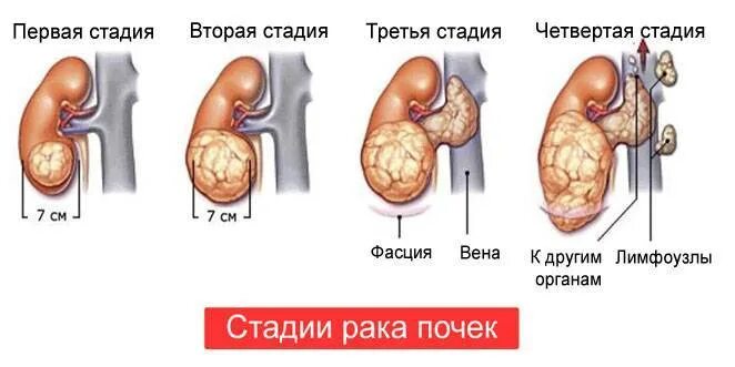 Рак яичек симптомы фото Рак почки у мужчин: симптомы, диагностика, лечение и прогноз