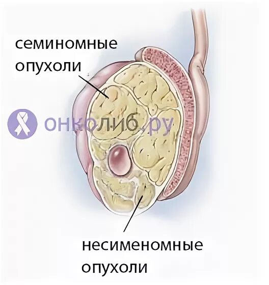 Рак яичек симптомы фото Рак яичек: причины, проявления, стадии, прогноз, как лечить - Онкология