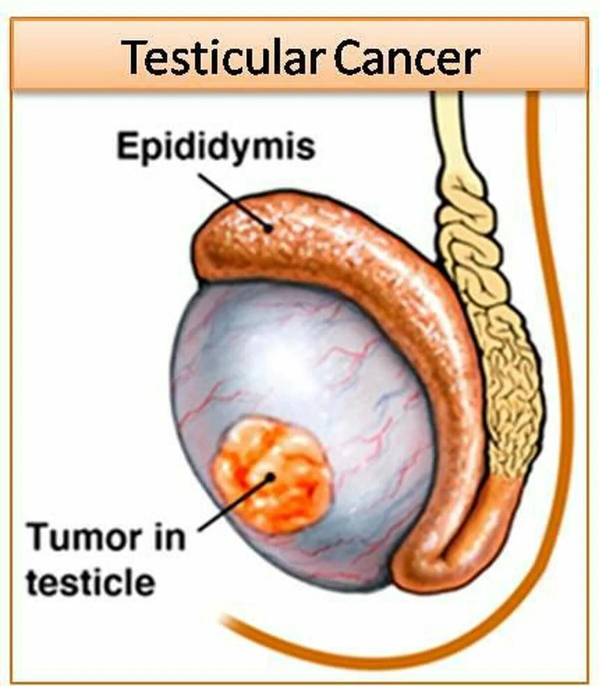 Рак яичек симптомы фото What Are The Clinical Manifestations Of Testicular Cancer Quizlet