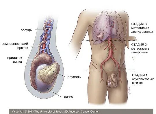 Рак яичек симптомы фото Удаление яичка при раке - орхифуникулэктомия