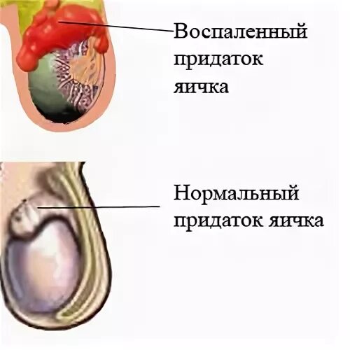 Рак яичек у мужчин симптомы фото Эпидидимит. Все о нем