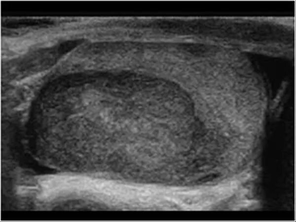 Рак яичка фото снаружи Urinary Tract and male reproductive system 2.3 Scrotum : Case 2.3.8 Testis tumor