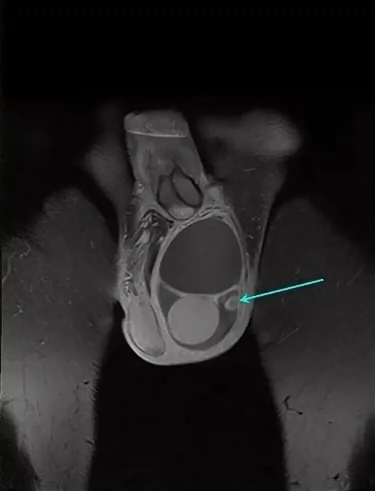 Рак яичка фото снаружи МРТ мошонки и полового члена: органов, яичек у мужчин что показывает