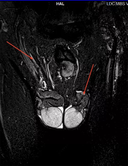 Рак яичка фото снаружи МРТ мошонки в Сургуте