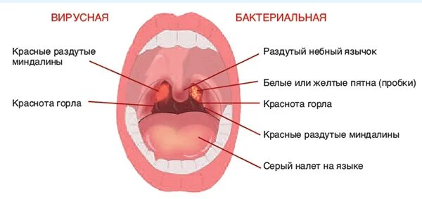 Рак язычка в горле фото Вирусная ангина: симптомы и признаки, как выглядит горло, как отличить от бактер