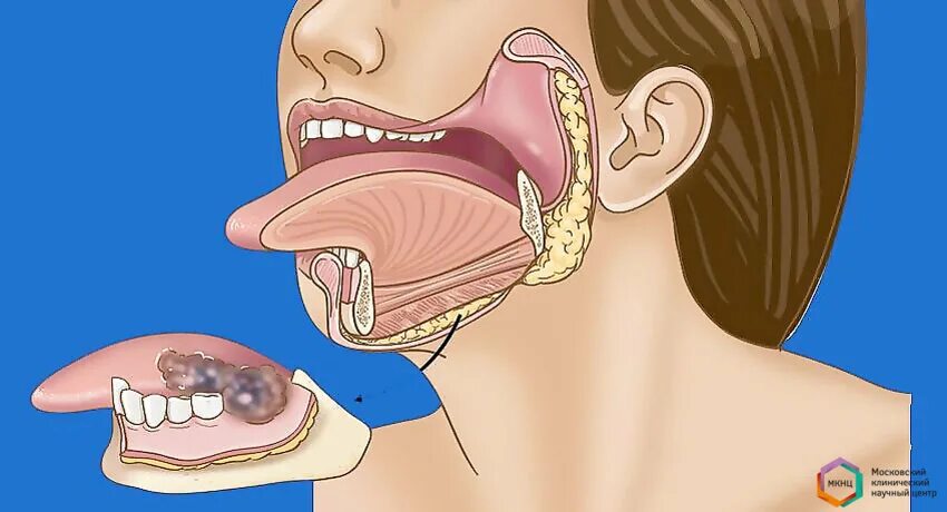 Рак языка 1 стадия фото Рак языка 4ой степени и Я. Часть 4 Алексей 063 Дзен
