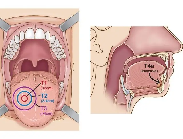 Рак языка 4 стадия фото Cancer of the tongue: stages, photos, signs and symptoms Cancer 2024