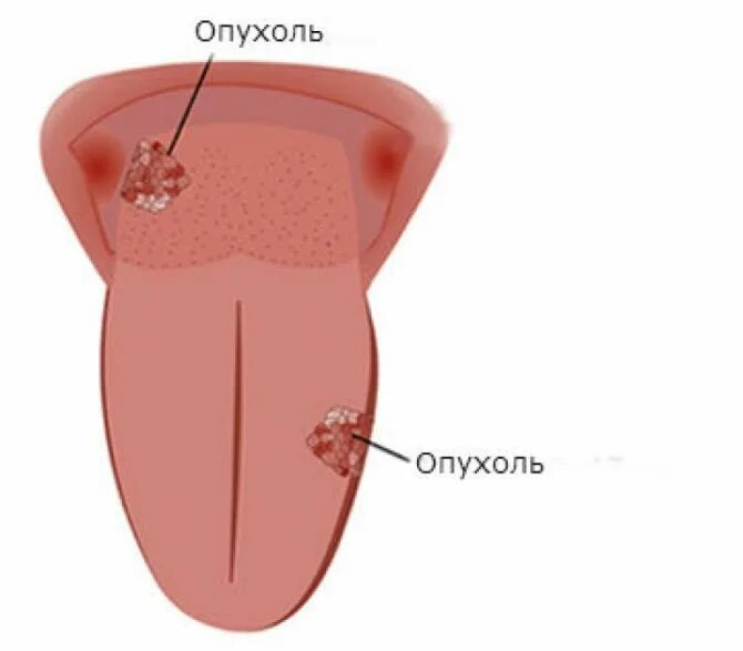 Рак языка первой стадии фото Почему появился нарост на языке, способы удаления папилломы - полезная информаци