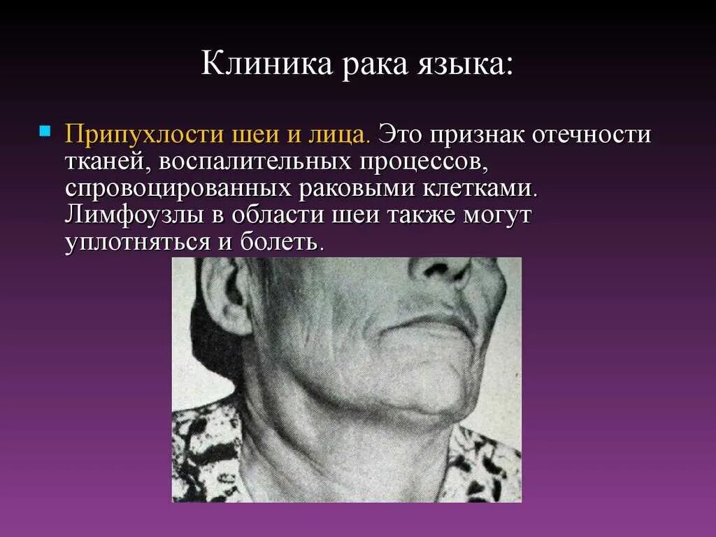 Рак языка стадии фото Рак (онкология) языка: стадии опухоли, первые признаки, виды, причины, симптомы,