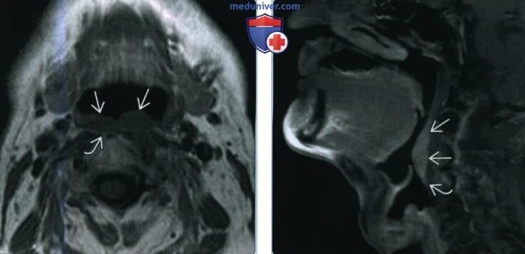 Рак задней стенки горла фото Плоскоклеточный рак задней стенки ротоглотки - лучевая диагностика